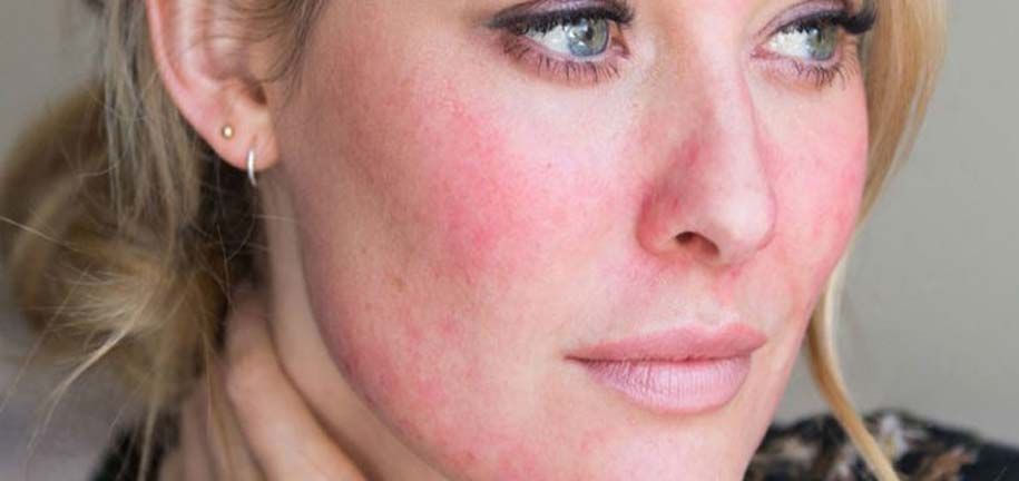 Dry and Irritated Skin