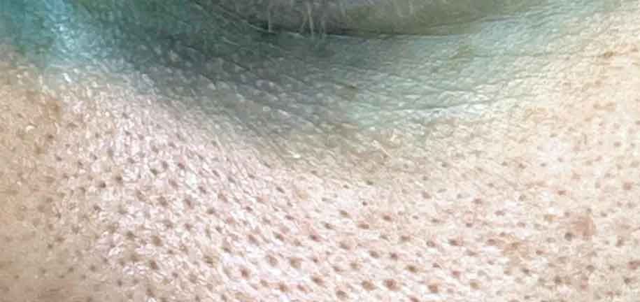 How to Get Rid of Enlarged Pores on Face
