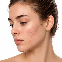 Skincare for Acne Prone Skin