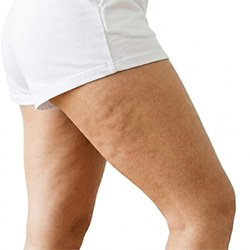 Cellulite skin care products for body care