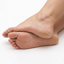 Cracked feet care products for dry, rough, and hardened heels