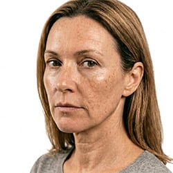 dark spots and hyperpigmentation