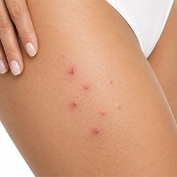 Professional ingrown hair care products for smoother looking skin on face and body