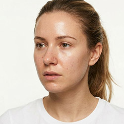 Skincare for Oily Skin