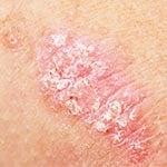 Psoriasis Skin Care and Treatments For Body and Scalp