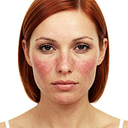 Facial redness and rosacea