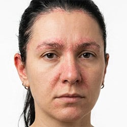Seborrhea Skin Care for Face and Scalp