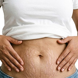 Skin care products for stretch marks and body skin